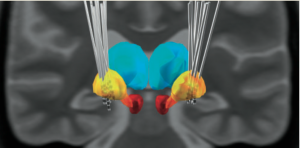barow_brain_lead_dbs