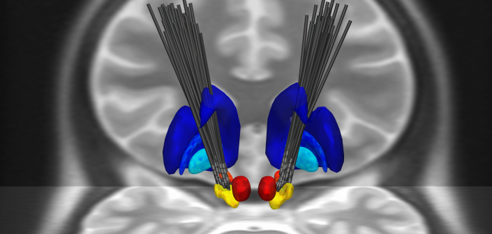 Electrode-Group-Analysis using the ATAG-Atlas